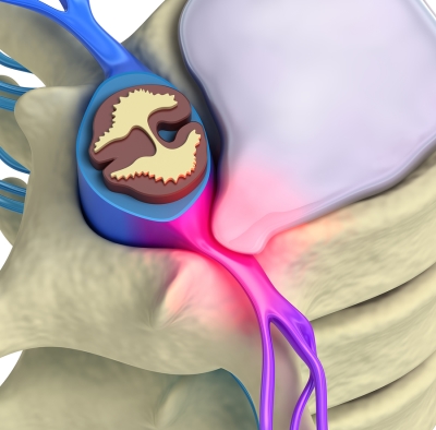 rendered illustration of herniated disk